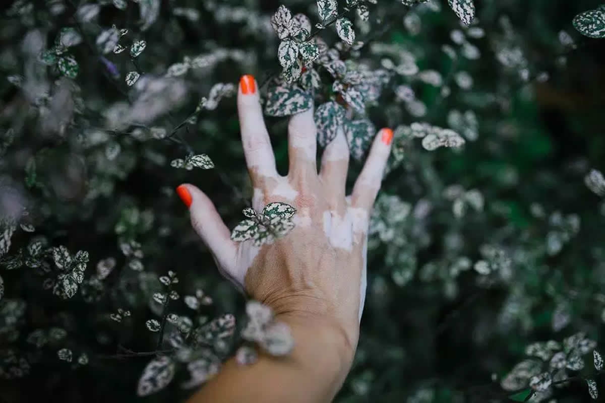 Vitiligo